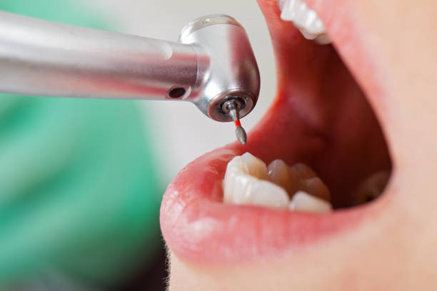 Best Lost Filling or Crown Replacement in Craigsville, WV